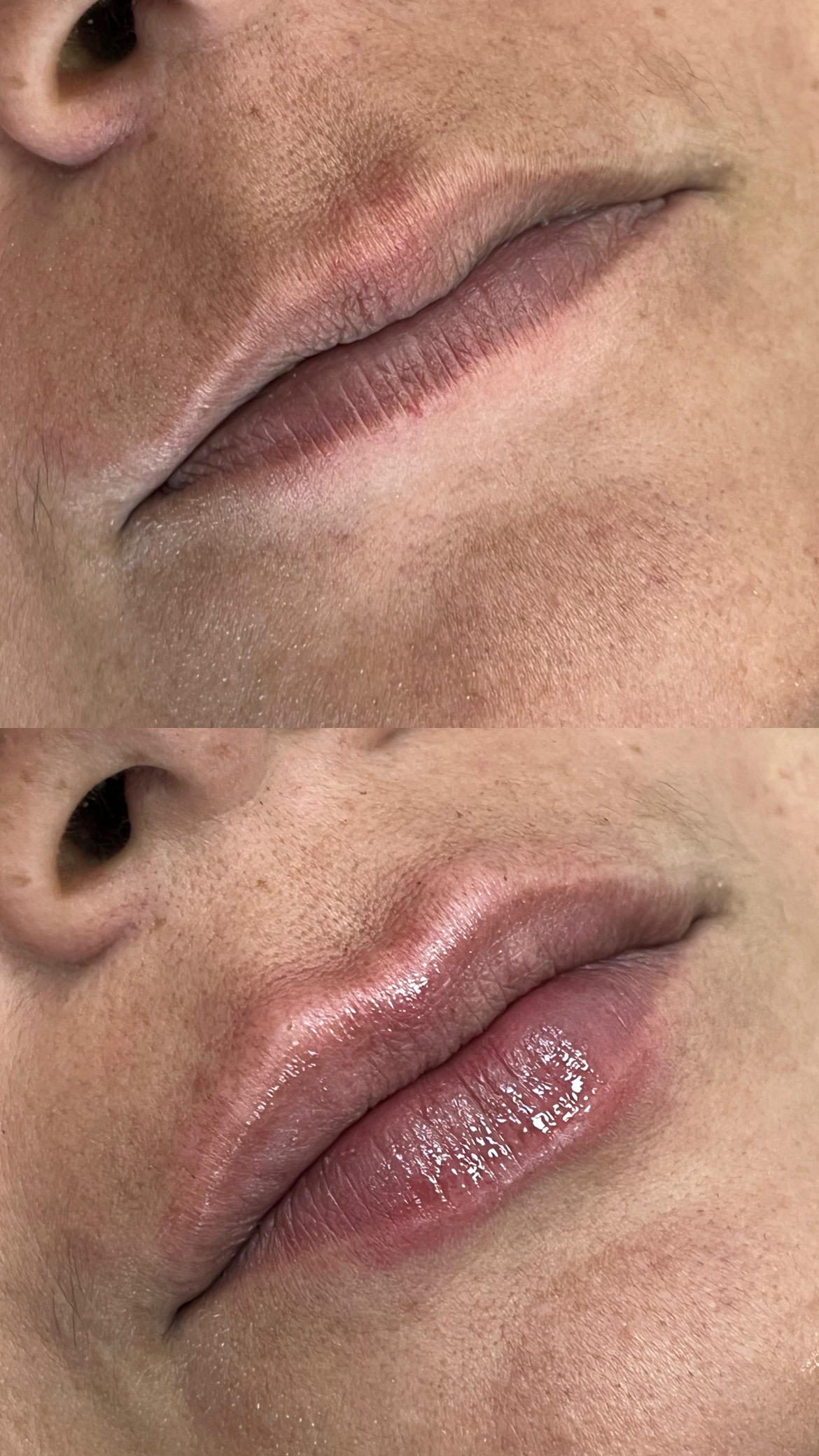 Antes e depois preenchimento labial