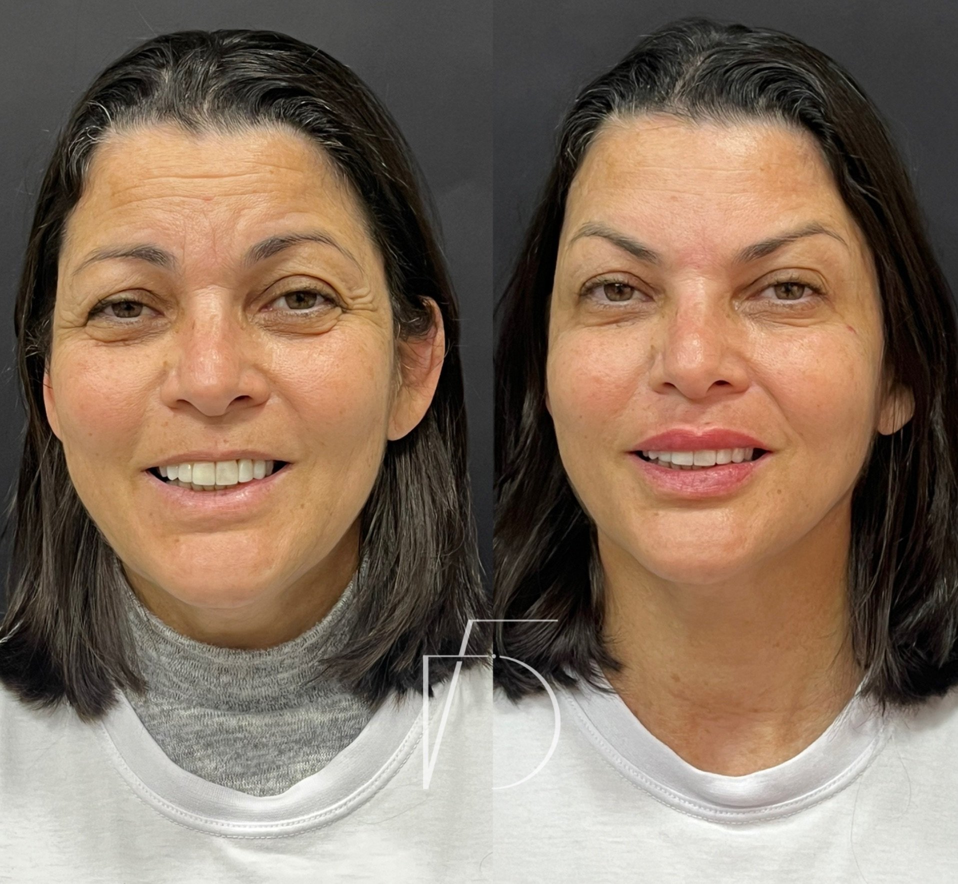 Antes e depois harmonização