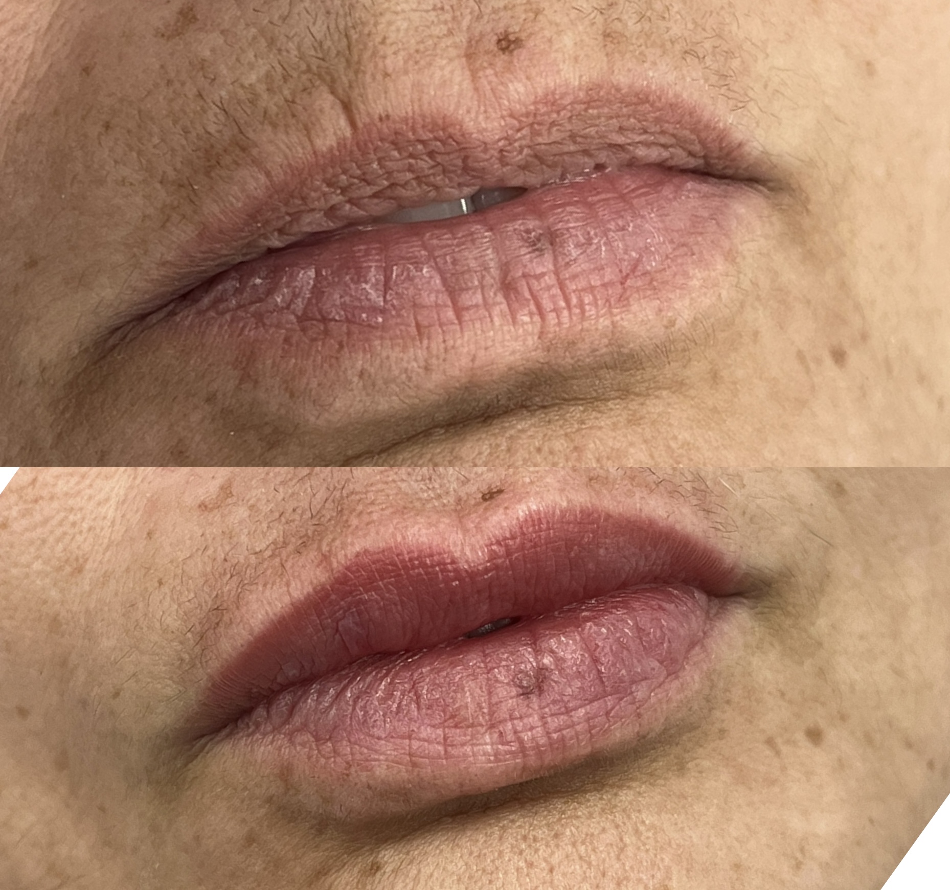 Antes e depois preenchimento labial