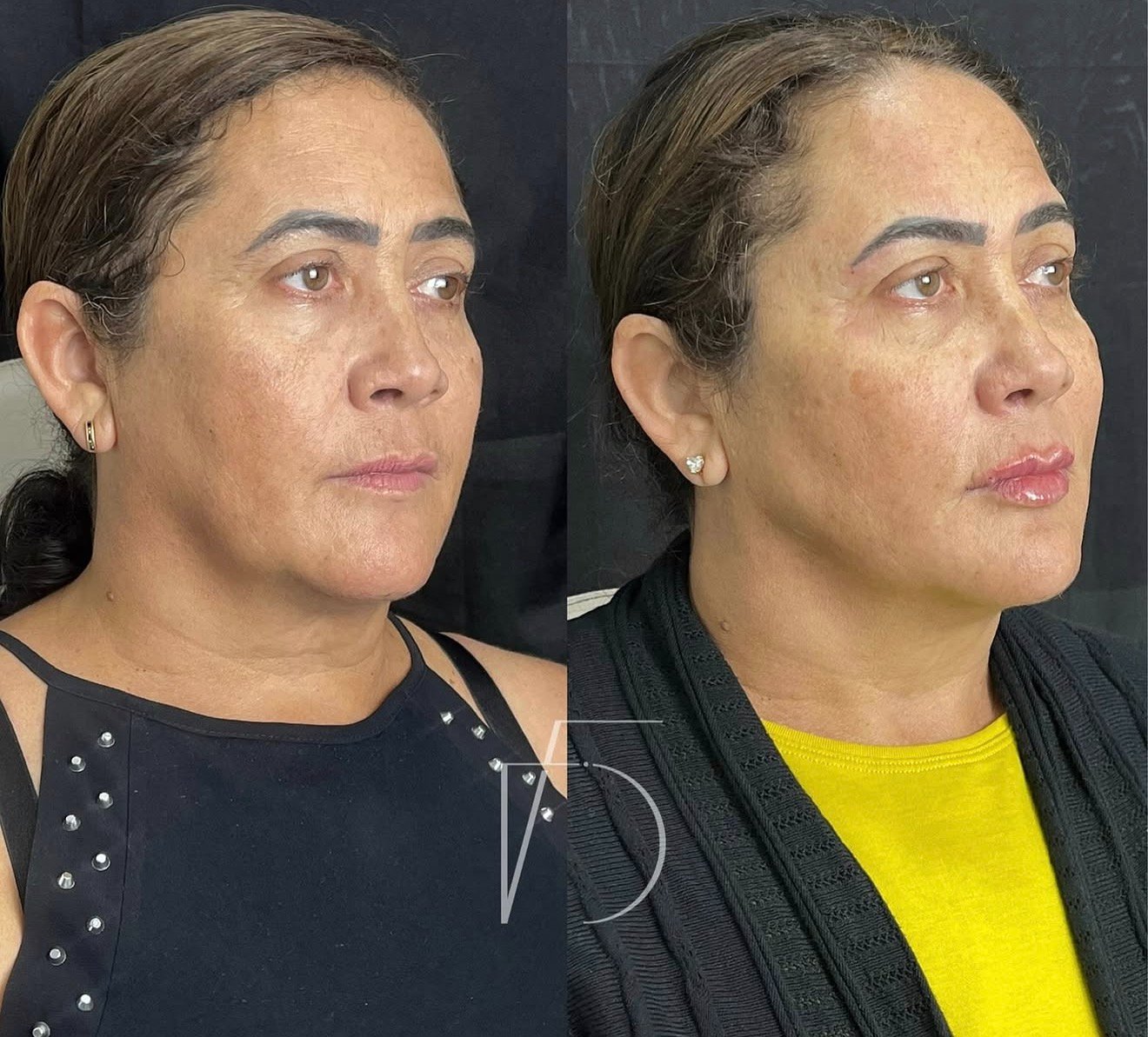 Antes e depois harmonização