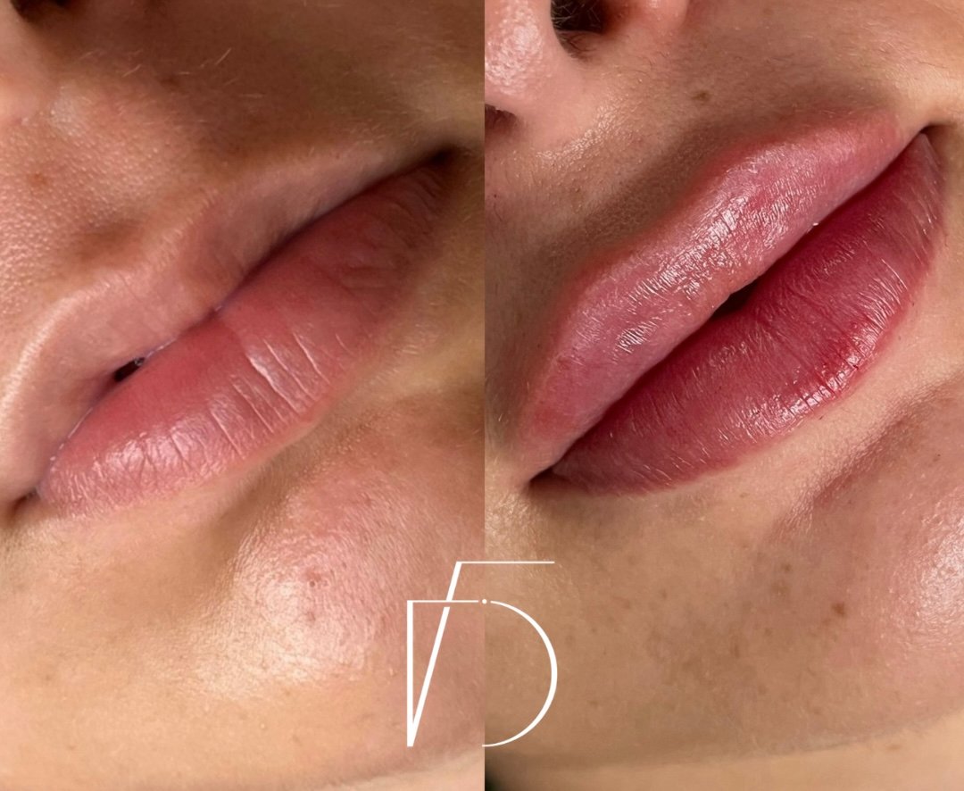 Antes e depois preenchimento