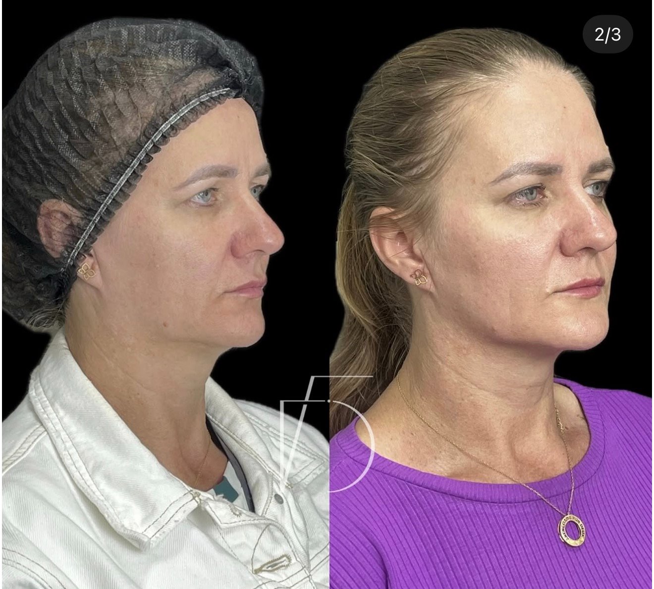 Antes e depois bioestimulador